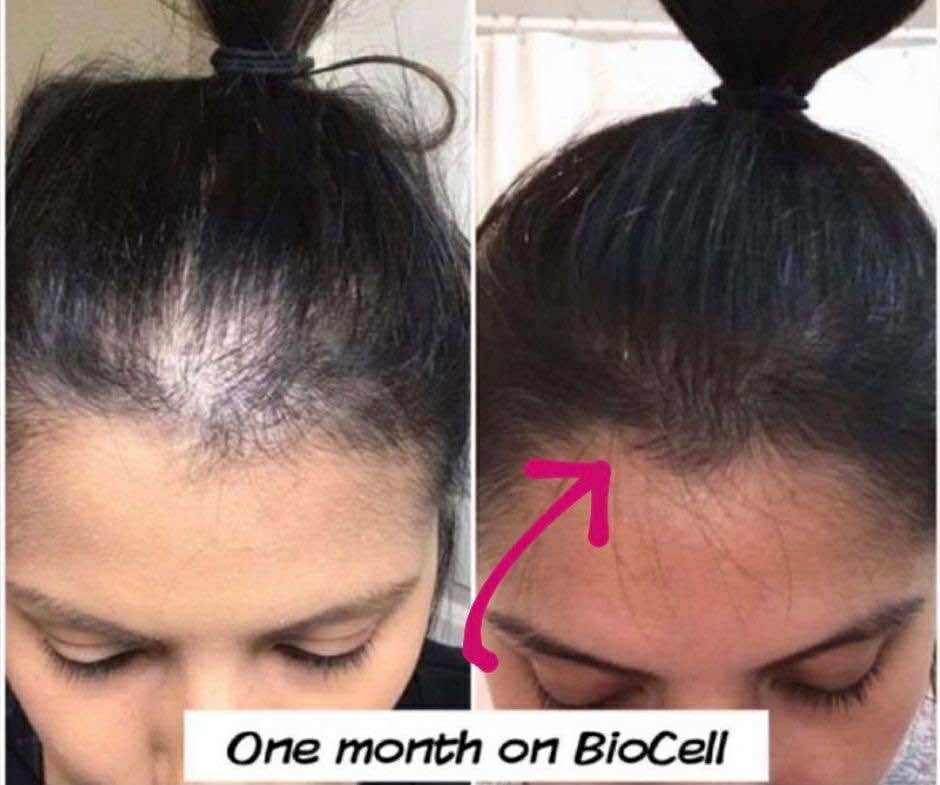 Hair regrowth — 1 month