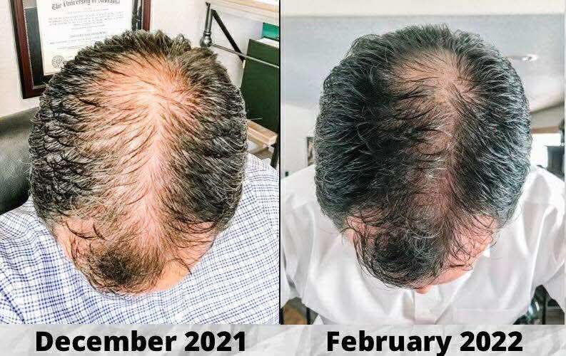 Hair regrowth — 2 months