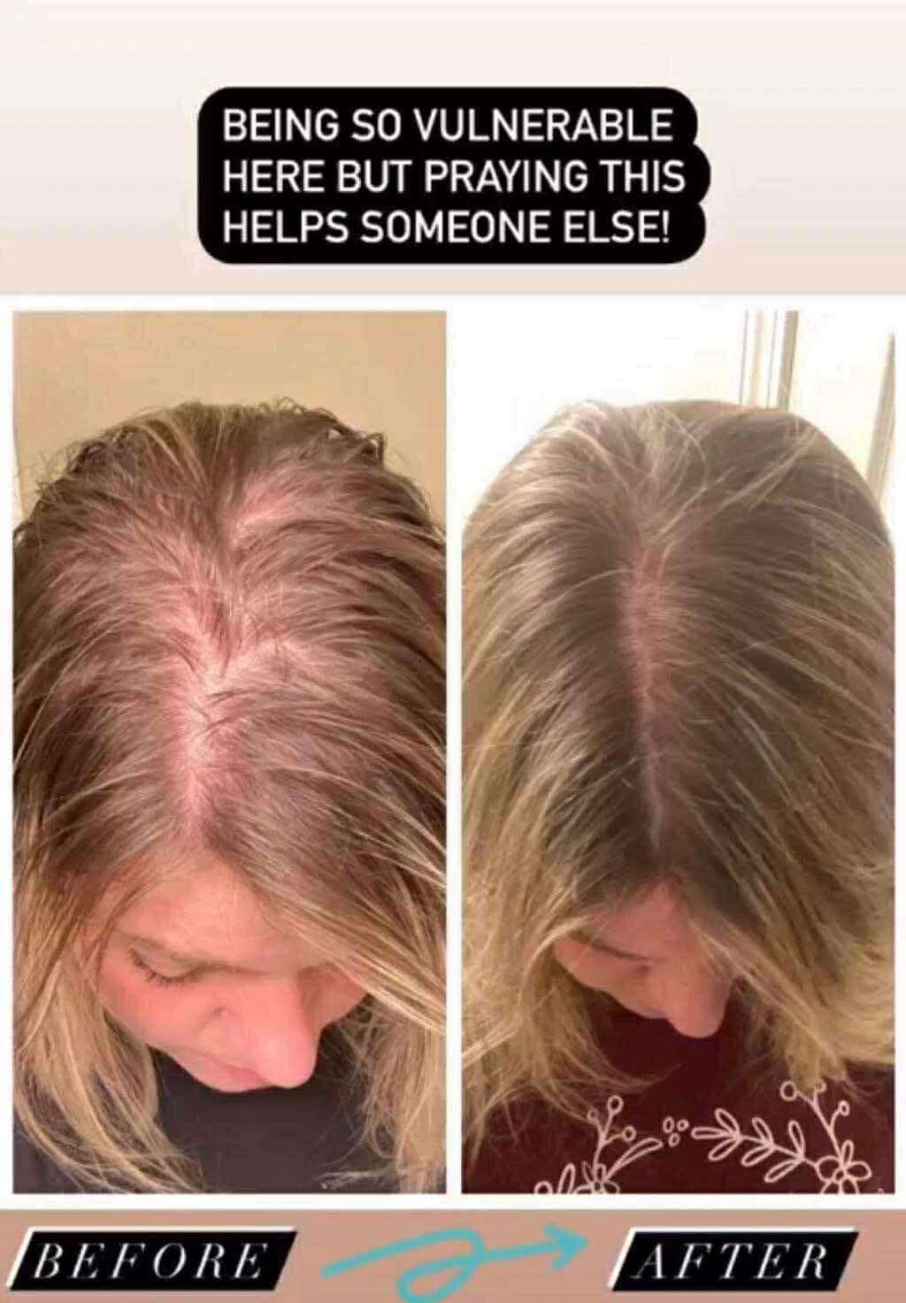 Hair regrowth — before/after