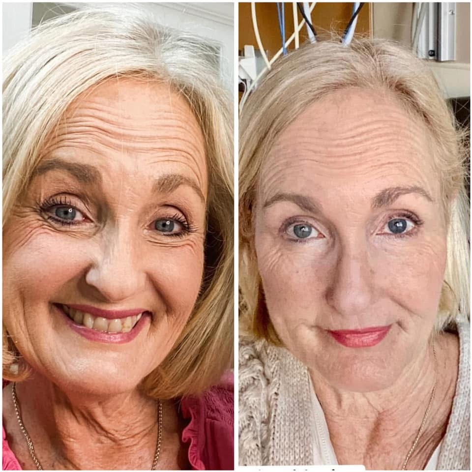 Skin result