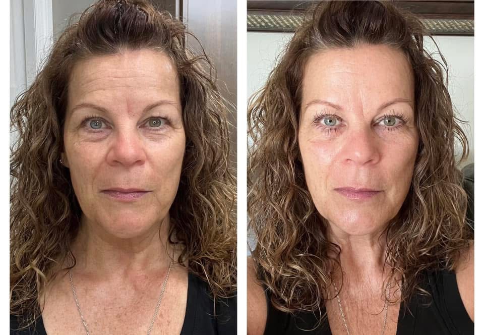 Skin result — before/after