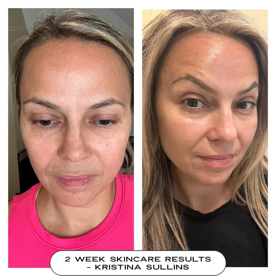 Skin result — 2 weeks