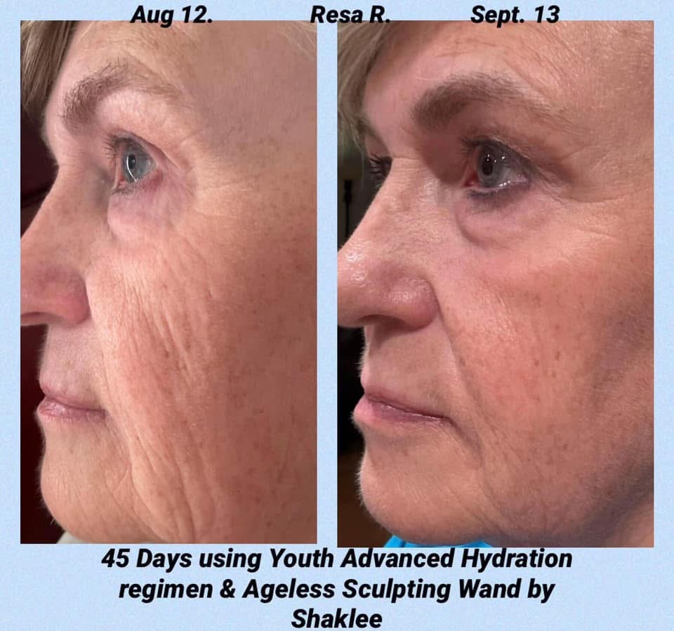 Skin result — 45 days